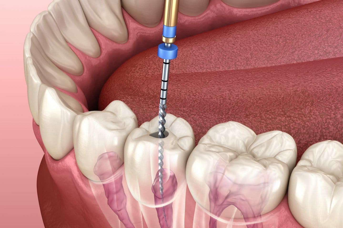 Root Canal Treatment 