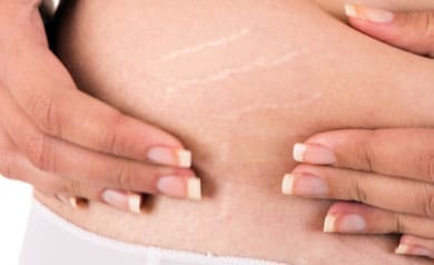 Stretch Marks Removal Treatment